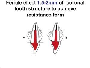 Ferrule and coronal tooth structures | Dentistry, Dental student, Dental crowns