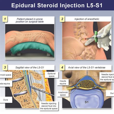 Epidural Steroid Injection Procedure - Trial Exhibits Inc.