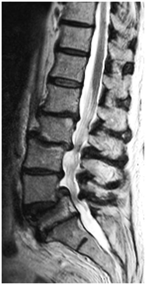 Lumbar Spine Mri Bulging Disc