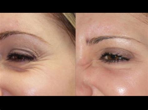 Before and after botox for crows feet. Feet Treatment, Eye Treatments ...