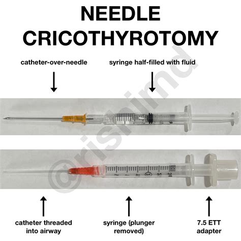 Needle Cricothyrotomy | RK.MD