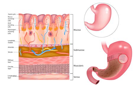 What is Stomach Cancer? | Roswell Park Comprehensive Cancer Center ...