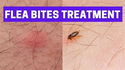 how to treat flea bites at home | ways to get rid of flea bites - YouTube