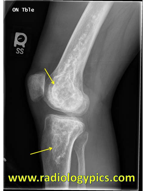 Bone Infarcts | RADIOLOGYPICS.COM