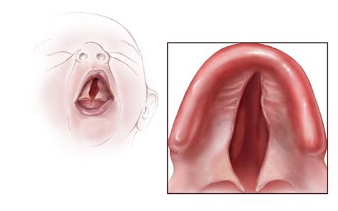 Goldenhar Syndrome : Causes, Picture, Symptoms And Treatment