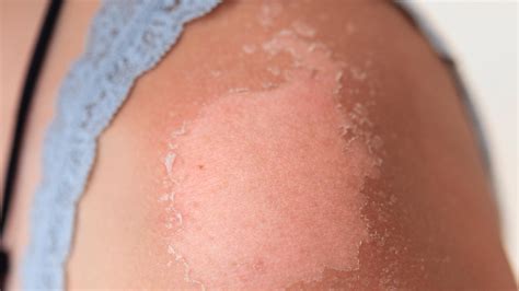 Why Your Skin Peels After a Sunburn, According to Dermatologists | Allure