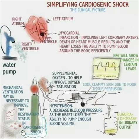 Cardiogenic shock | Work | Pinterest