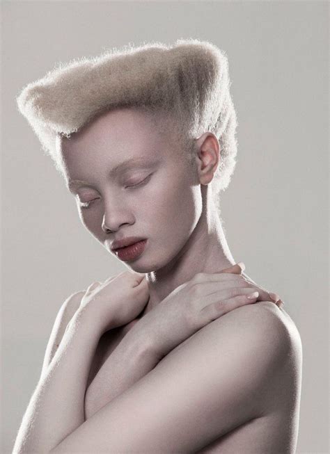 Pin by Rachael on Attractive People | Albino model, Albinism, Dingwall