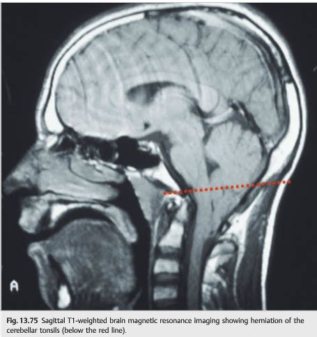 Neuro-ophthalmology Illustrated Chapter 13 – 4 – 6th Nerve Palsy — Neuro-Ophthalmology