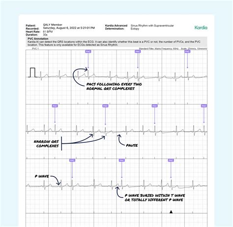 Atrial Bigeminy Vs. Atrial Trigeminy on Your Watch ECG | Qaly