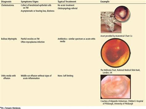 Ear Infection Middle Ear Otitis Media Symptoms And Ca - vrogue.co