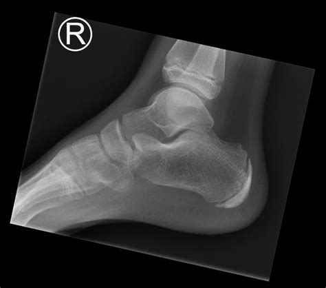 Normal Foot Xray Child