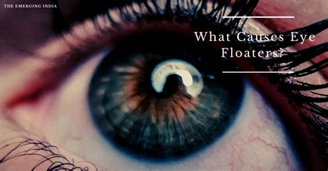 What Causes Eye Floaters? Symptoms, Treatments & Causes