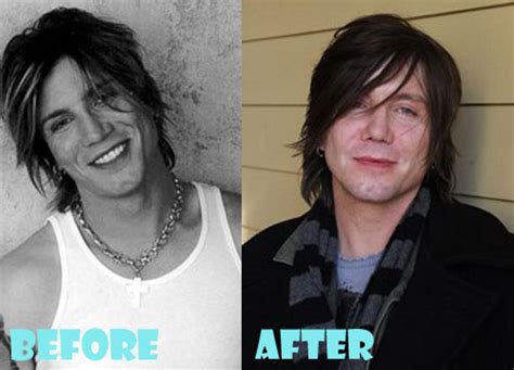 John Rzeznik Plastic Surgery Before and After Picture - Lovely Surgery