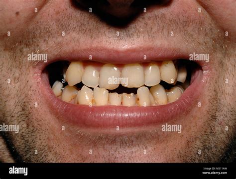 teeth of European man in his 30s Stock Photo - Alamy