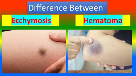 Ecchymosis Vs Bruise