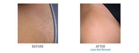 Laser Hair Removal 19053 | Laser Hair Removal Bucks County