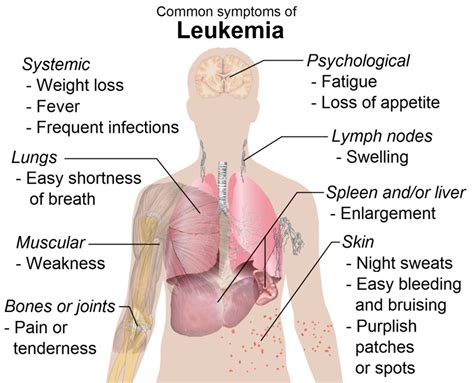 Common symptoms of leukemia - DocCheck