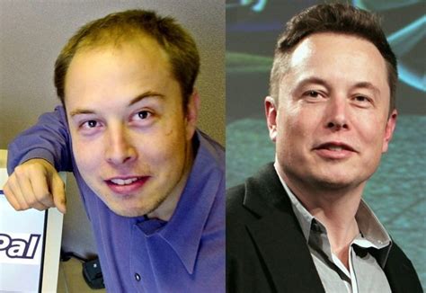 Elon Musk’s Hair Regrowth: How Did He Do It? : Hairy Jimbo