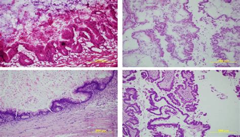 (200x) Upper Left: Frozen Section examination of a mucinous borderline ...