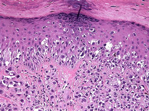 Acral Lentiginous Melanoma - Surgical Pathology Clinics