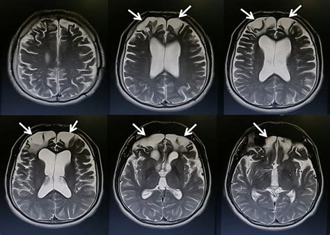 Mri Scan Brain Damage