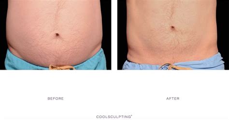 Coolsculpting At Home Kit Reviews | Review Home Co