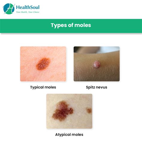 List 98+ Pictures Anatomy Of A Mole On The Skin Updated