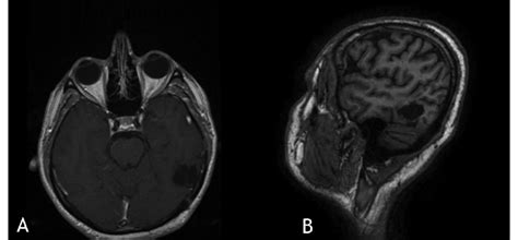 Late postoperative contrast-enhanced T1-weighted MRI images,... | Download Scientific Diagram