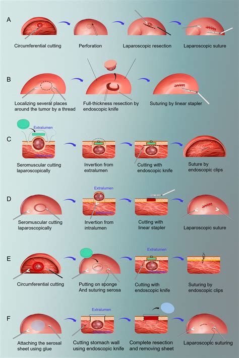 Frontiers | Laparoscopic and endoscopic cooperative surgery for early gastric cancer ...