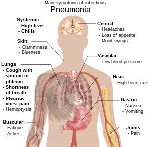 Pneumonia - Wikipedia, the free encyclopedia