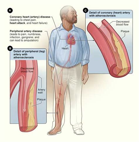 Smoking and Your Heart - How Smoking Affects the Heart and Blood ...