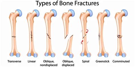 Long bone anatomy, structure, parts, function and fracture types