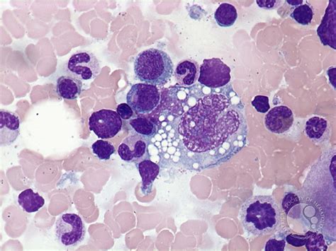 Anaplastic large cell lymphoma - bone marrow aspirate - 2.