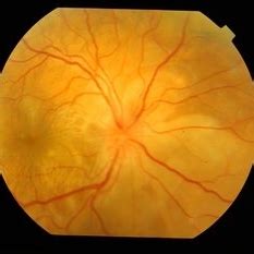 Multifocal Choroiditis - Retina Image Bank