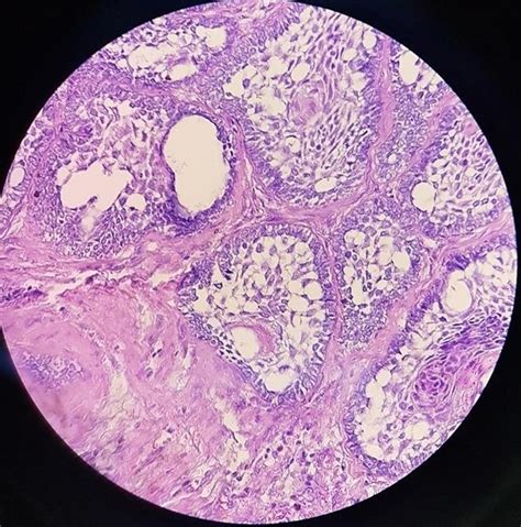 Ameloblastoma Histology