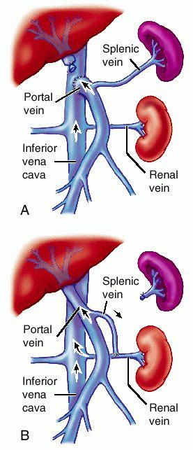 Pulmonary shunt | definition of Pulmonary shunt by Medical dictionary