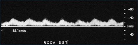 Tardus parvus waveform, distal to a high grade stenosis | Stenosis, Plaque, Vulnerability