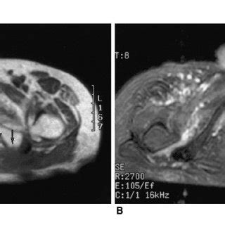 (PDF) Non-infectious ischiogluteal bursitis: MRI findings