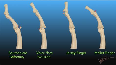 Finger Fractures | UW Emergency Radiology