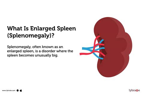 Enlarged Spleen (Splenomegaly): Symptoms, Causes Treatment, 55% OFF