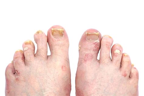 Psoriasis and Psoriatic Arthritis of the Toe Nails and Feet | A Step ...