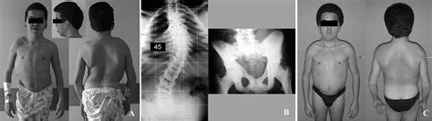 Osteopetrosis