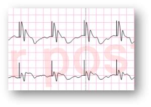 Transcutaneous pacing - WikEM