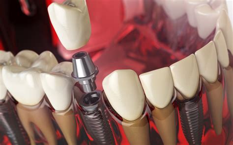 DENTAL IMPLANTS VS DENTURES.WHAT’S THE DIFFERENCE?