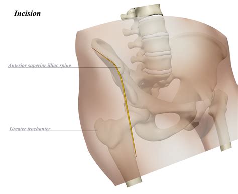 Hip Anterior Approach (Smith-Petersen) - Approaches - Orthobullets