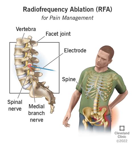 Radiofrequency Ablation for Pain Management - Amara Pain & Spine Management