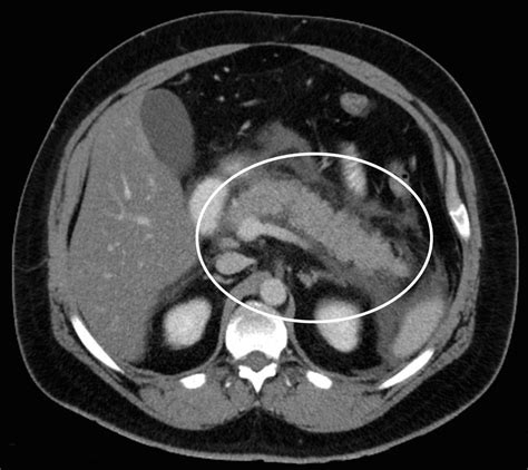 Acute Pancreatitis - Stepwards