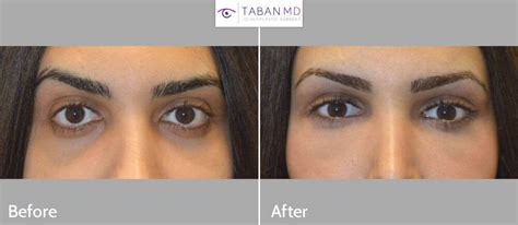 Almond Eye Surgery Before and After Gallery | Taban MD