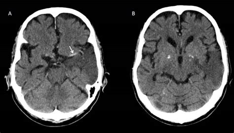 Dense MCA sign – Radiology Cases